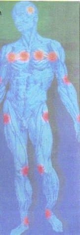 Fibromyalgia, What a Pain